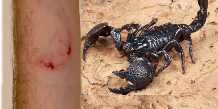 ಚೇಳು ಕಚ್ಚಿದಾಗ ಏನು ಮಾಡಬೇಕು? ಮನೆಯಲ್ಲಿರೋ ಔಷಧಿಗಳ್ಯಾವುವು ಗೊತ್ತಾ?