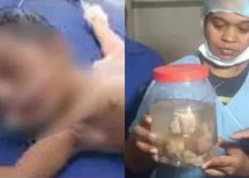 21 ದಿನದ ಶಿಶುವಿನ ಹೊಟ್ಟೆಯಲ್ಲಿತ್ತು 8 ಭ್ರೂಣ..!