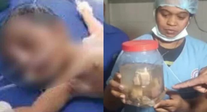 21 ದಿನದ ಶಿಶುವಿನ ಹೊಟ್ಟೆಯಲ್ಲಿತ್ತು 8 ಭ್ರೂಣ..!