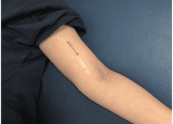 ಈ ಸಾಧನ ತೋಳಿನಲ್ಲಿದ್ದರೆ  ಏನು ಮಾಡಿದರೂ 3 ವರ್ಷ ಗರ್ಭಧಾರಣೆ ಆಗುವುದಿಲ್ಲ..!