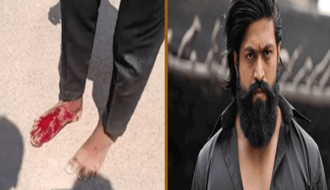 ಮತ್ತೊಬ್ಬ ಯಶ್‌ ಅಭಿಮಾನಿಯ ಅನಾಹುತ : ಕಾಲಿನ ಮೇಲೆ ಹರಿದ ಯಶ್‌ ಬೆಂಗಾವಲು ಕಾರು..!